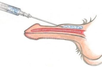 Eine gefährliche Methode zur Penisvergrößerung mittels Vaseline-Injektionen. 